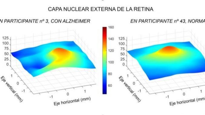 Comparación de dos capas de la retina de pacientes con y sin alzhéimer. Imagen cedida por la Universidad Complutense de Madrid. EFE