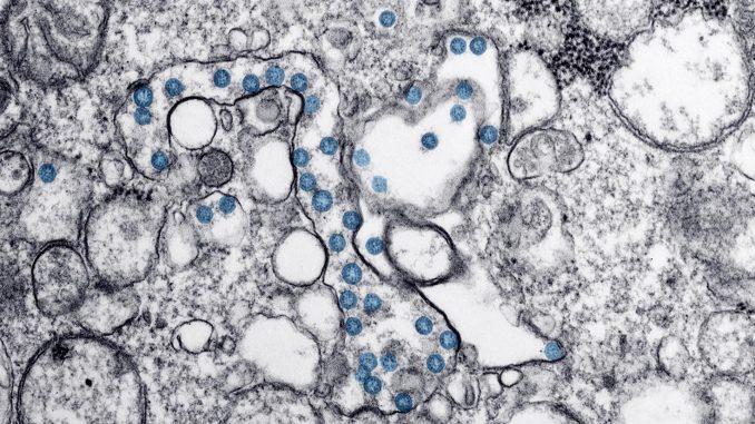 Partículas del virus SARS-CoV-2, coloreadas en azul, en una imagen de microscopio de electrones. Imagen cedida por el Consejo Superior de Investigaciones Científicas (CSIC). EFE
