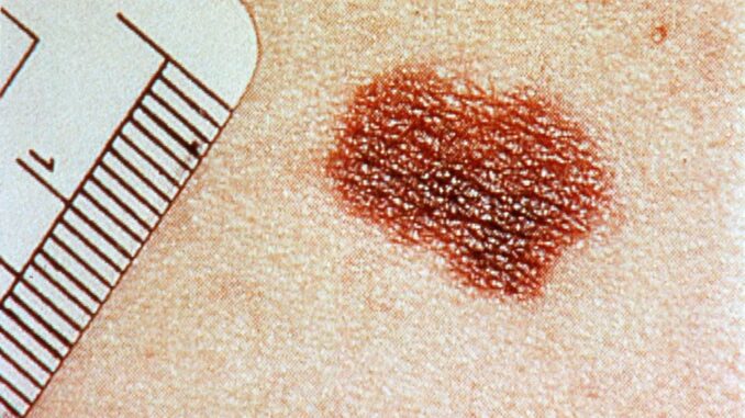 Melanoma, un tumor cutáneo asociado a la exposición al sol EFE/ [ARCHIVO]
