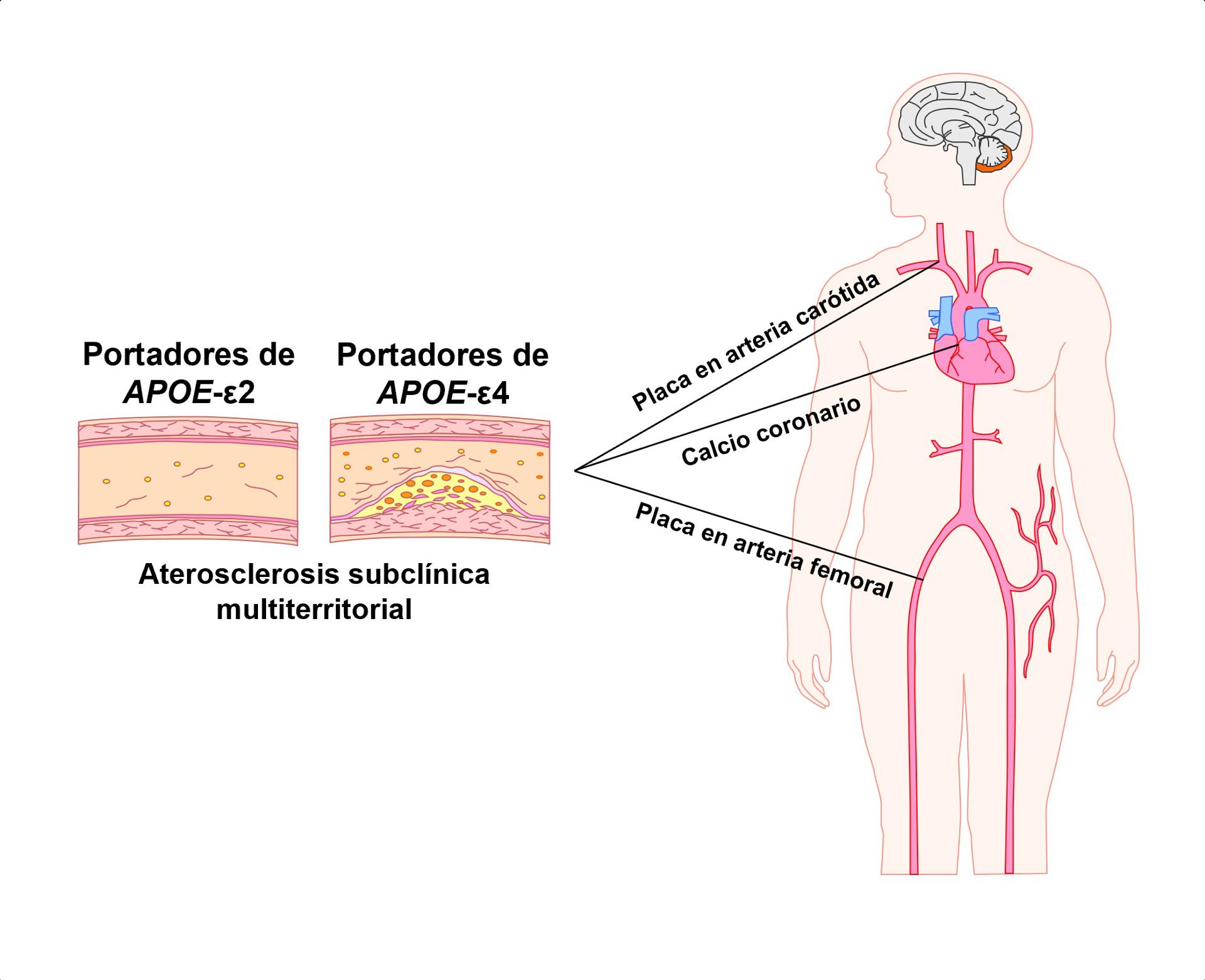 Un equipo de investigadores ha descubierto que una variante genética que está considerada como el factor de riesgo más potente para desarrollar la enfermedad del alzhéimer de inicio tardío está también asociada con un mayor riesgo de desarrollar aterosclerosis subclínica (asintomática). Imagen cedida por el CNIC.
