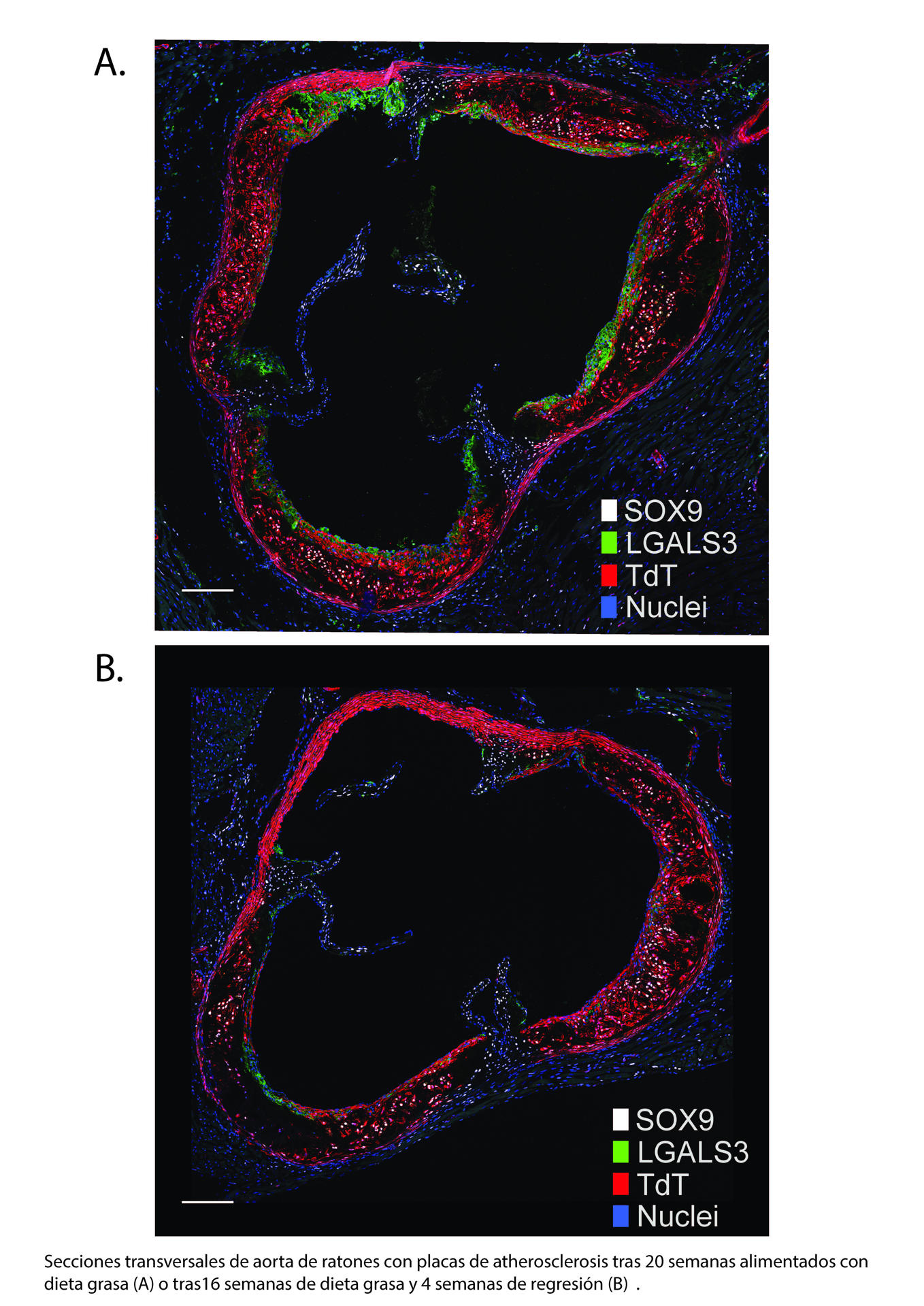 Secciones transversales de aorta de ratones con placas de aterosclerosis tras 20 semanas alimentados con dieta grasa (A) o tras 16 semanas de dieta grasa y 4 semanas de regresión. Científicos del Centro Nacional de Investigaciones Cardiovasculares (CNIC) español y de la universidad danesa de Aarhus, han descubierto una vía que va a permitir diseñar terapias para potenciar el efecto de los fármacos que se dirigen a reducir el colesterol en la sangre, principal causa de la aterosclerosis, responsable de muchas enfermedades cardiovasculares y cerebrovasculares (infartos o ictus). Lo han logrado científicos del Centro Nacional de Investigaciones Cardiovasculares (dependiente del Instituto de Salud Carlos III del Ministerio de Ciencia) de España y de la universidad danesa de Aarhus, que han identificado el mecanismo central que conduce a la regresión de la aterosclerosis tras la reducción del colesterol en plasma, y los resultados se han publicado en Nature Cardiovascular Research.-EFE/CNIC***SOLO USO EDITORIAL/SOLO DISPONIBLE PARA ILUSTRAR LA NOTICIA QUE ACOMPAÑA (CRÉDITO OBLIGATORIO)***
