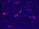 Tejido cerebral de un paciente con SCA4. El azul marca el ADN celular y el rojo una proteína que aumenta cuando se interrumpe el reciclaje de proteínas. El anillo rojo brillante es un grupo de proteínas que sólo aparece en pacientes con SCA4. Fotografía facilitada por  Mandi Gandelmanho. EFE